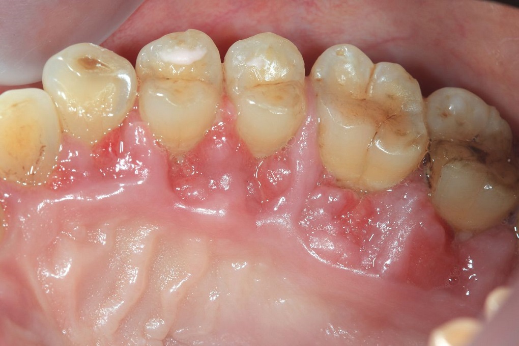 Những Biến Chứng Nguy Hiểm Khi Cấy Ghép Implant Quá Trễ