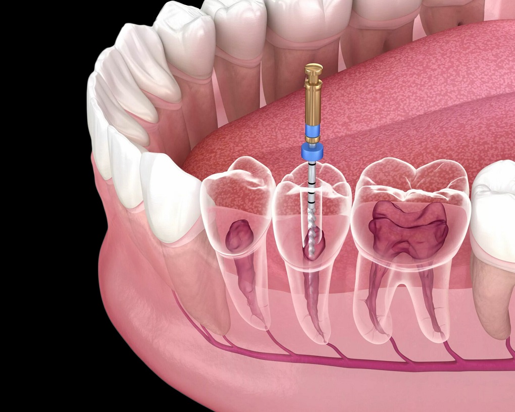 Những Việc Cần Làm Sau Khi Điều Trị Tuỷ Răng