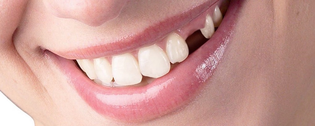 Răng Giả Tháo Lắp 1 Chiếc