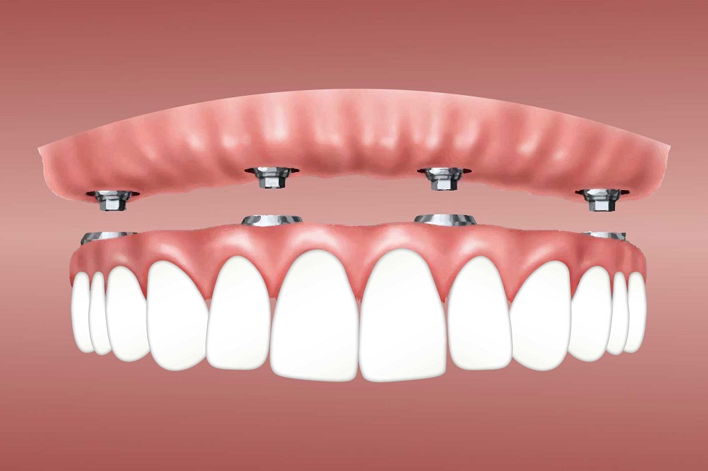 Thời Gian Chờ Làm Phục Hình Răng Implant Mất Bao Lâu