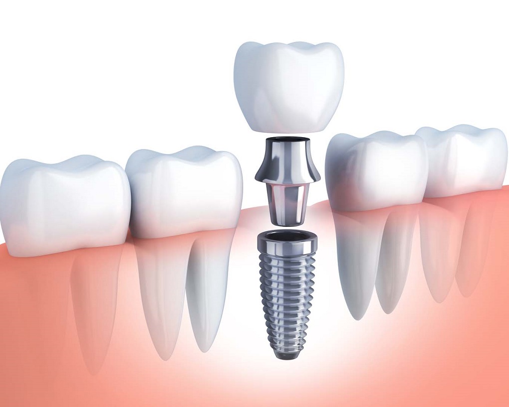Thời Gian Chờ Làm Phục Hình Răng Implant Mất Bao Lâu