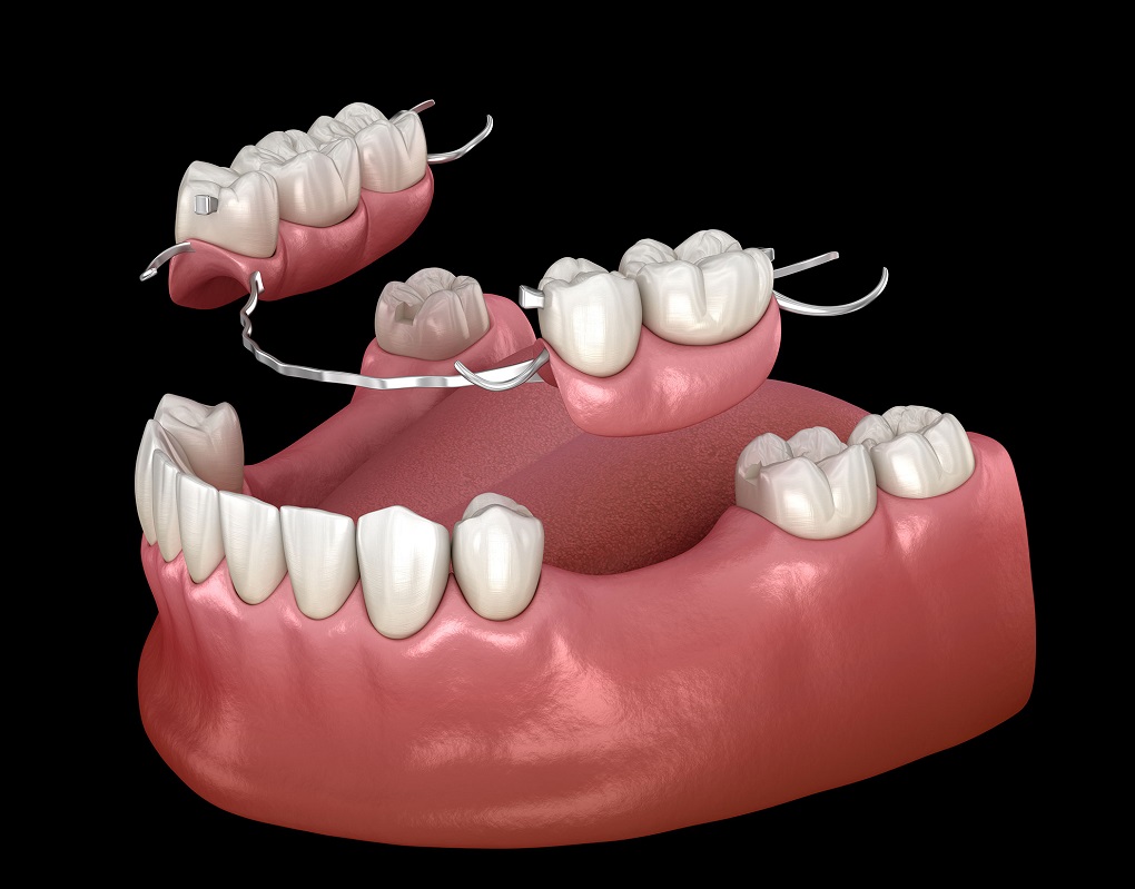 Răng Giả Tháo Lắp Bán Phần