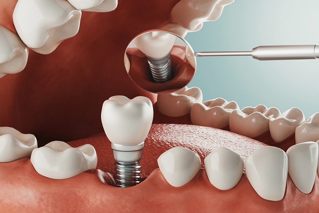Răng implant có tuổi thọ bao lâu