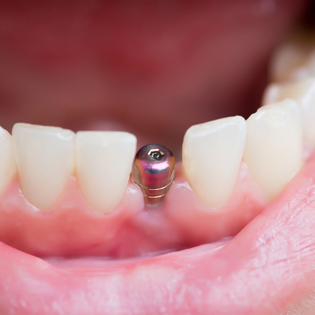 Răng implant có tuổi thọ bao lâu