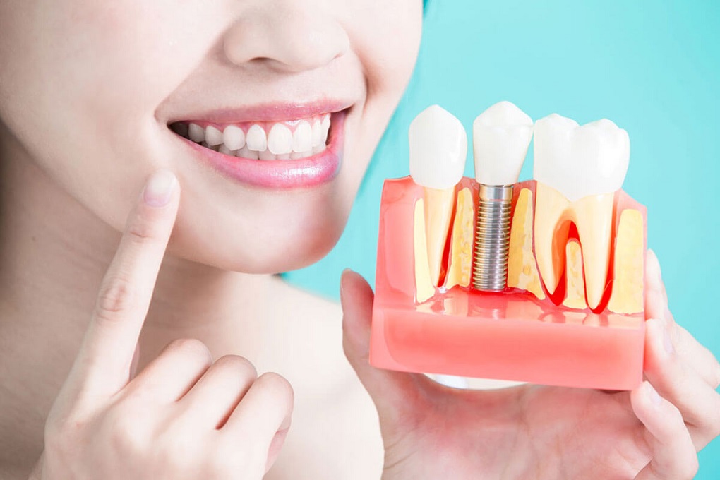 Răng implant có tuổi thọ bao lâu