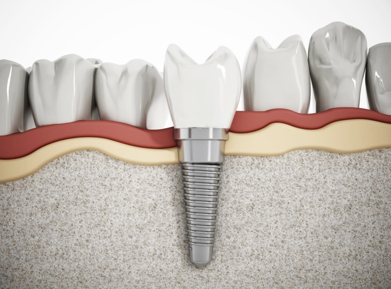Nha khoa trồng răng Implant uy tín