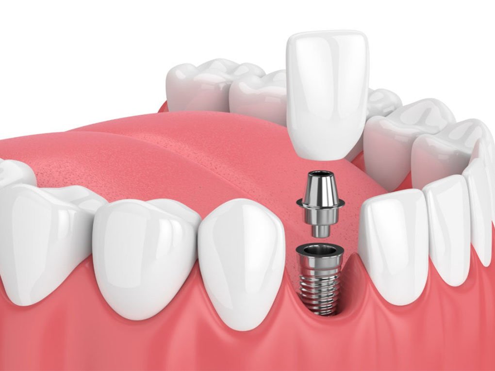 Trồng Răng Implant Có Đau Không