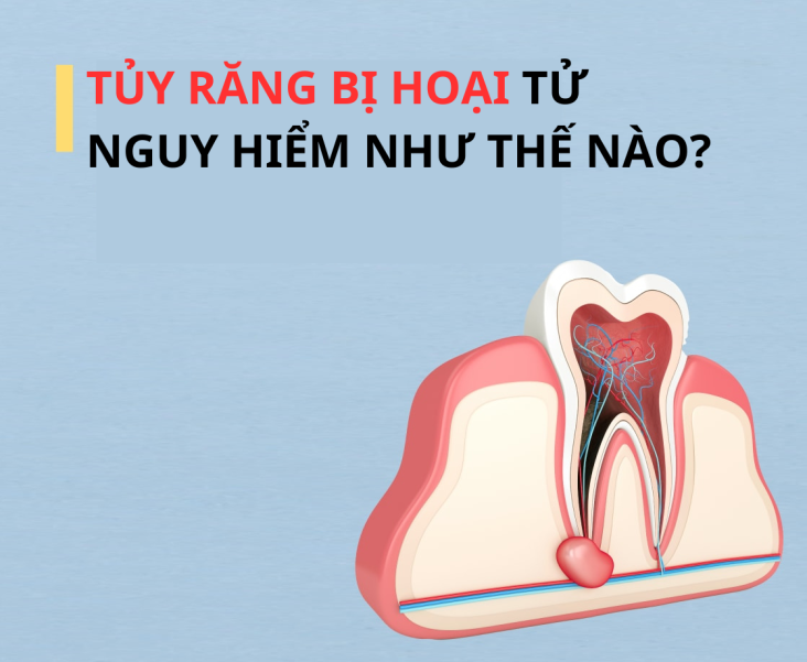Tủy răng bị hoại tử nguy hiểm như thế nào