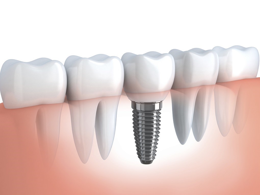 Công Nghệ Trồng Răng Implant