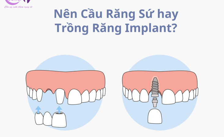 Nên Cầu Răng Sứ hay Trồng Răng Implant