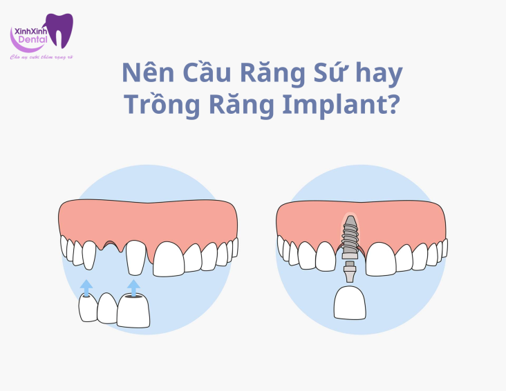 Nên Cầu Răng Sứ hay Trồng Răng Implant