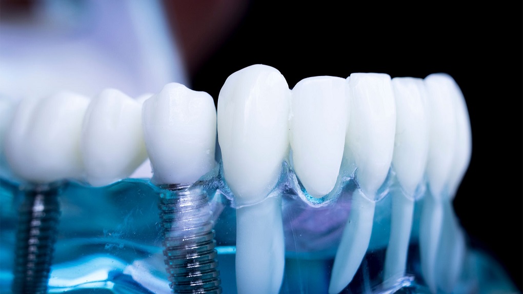 Ưu và Nhược điểm khi trồng răng implant