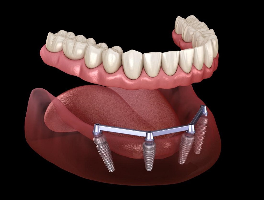 Ưu và Nhược điểm khi trồng răng implant