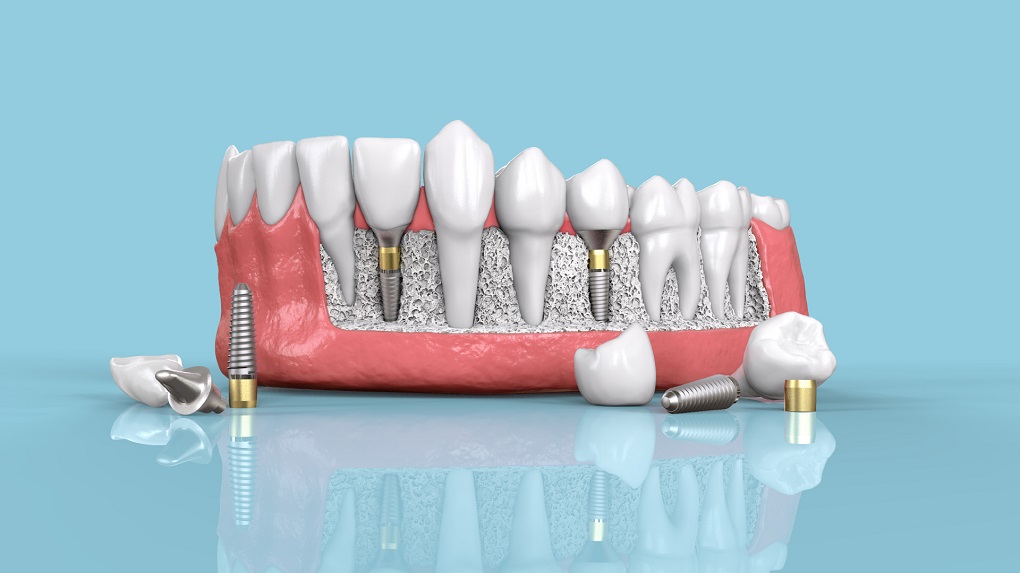 Ưu và Nhược điểm khi trồng răng implant