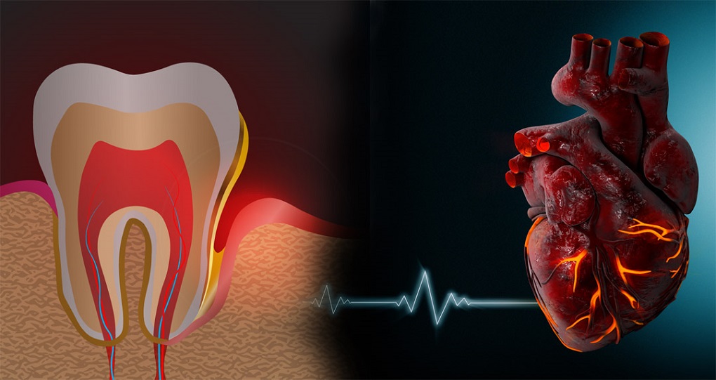 Bệnh viêm nha chu và các bệnh tim mạch 