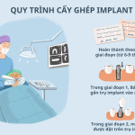 Quy Trình Cấy Ghép Implant Tại Nha Khoa