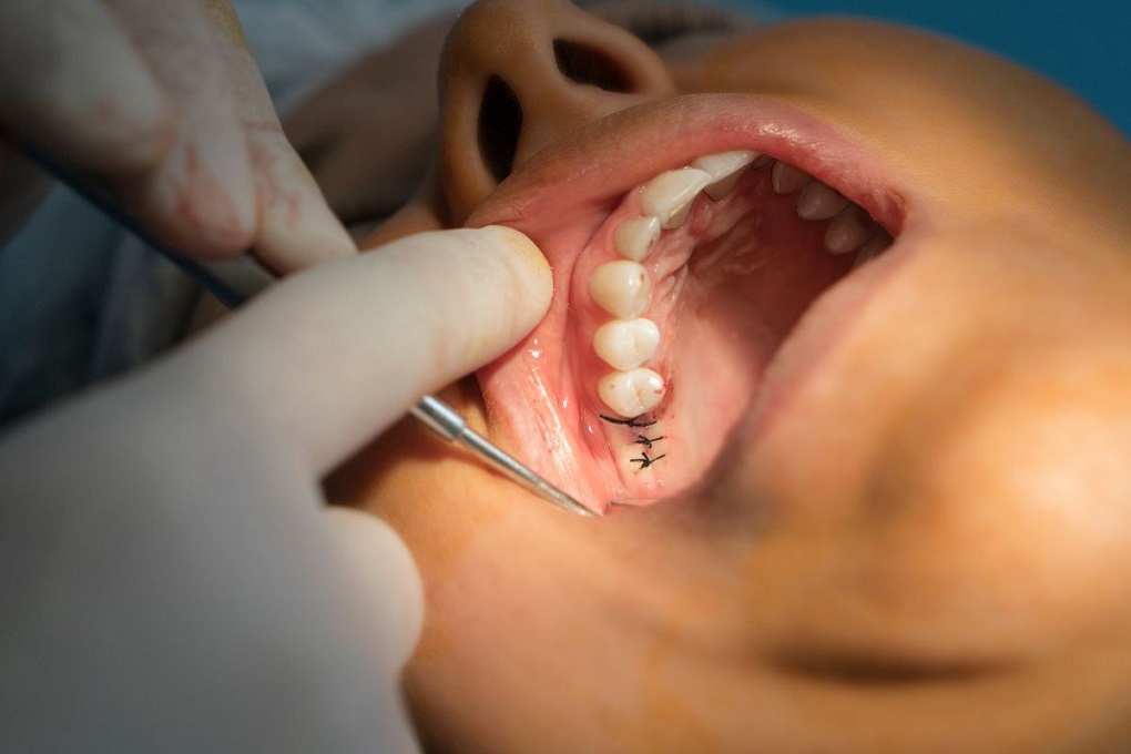 Trồng Răng Implant Có Nguy Hiểm Gì Không 