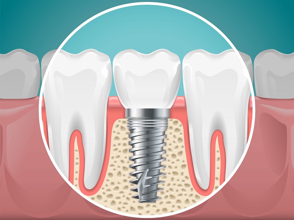 Trồng Răng Implant Có Nguy Hiểm Gì Không 