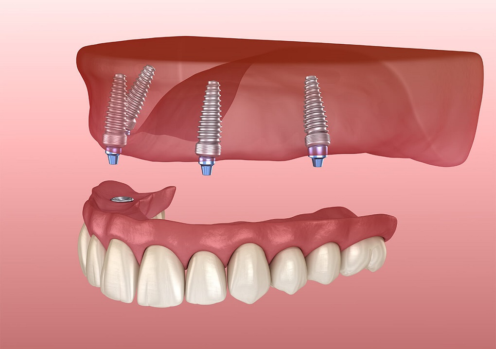 Trồng Răng Implant Nguyên Hàm