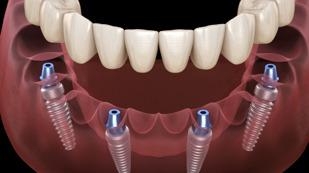 Trồng Răng Implant Toàn Hàm All On 4 và All On 6