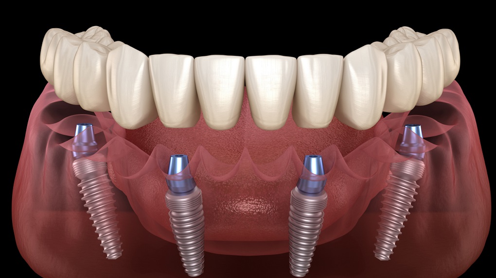 trồng răng Implant All On 4 