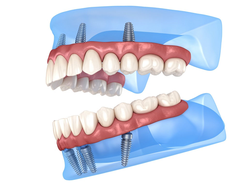 trồng răng Implant All On 4 