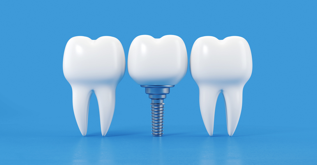 Phục Hình Răng Sứ Trên Implant