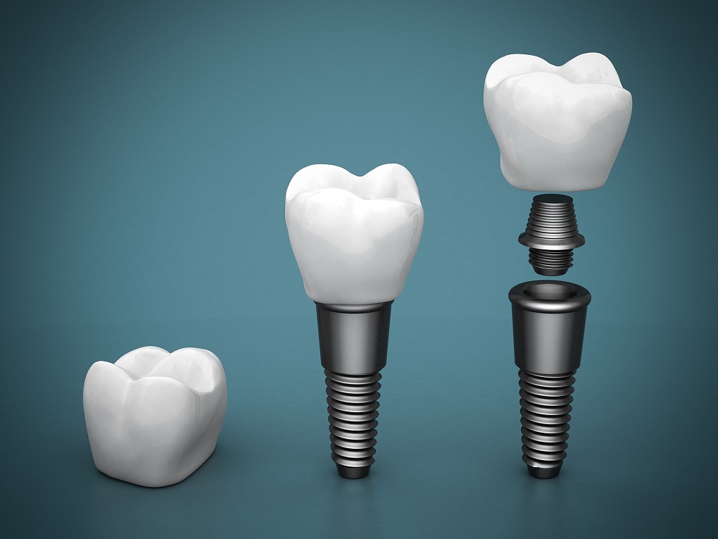 Phục Hình Răng Sứ Trên Implant