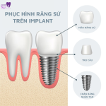 Phục Hình Răng Sứ Trên Implant