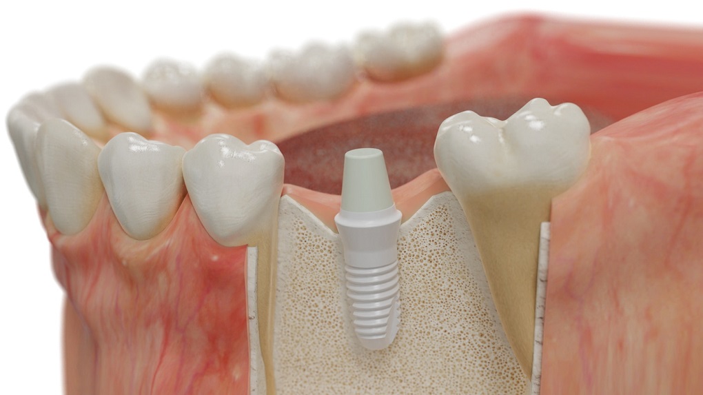 Phục Hình Răng Sứ Trên Implant