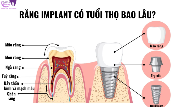 Răng implant có tuổi thọ bao lâu